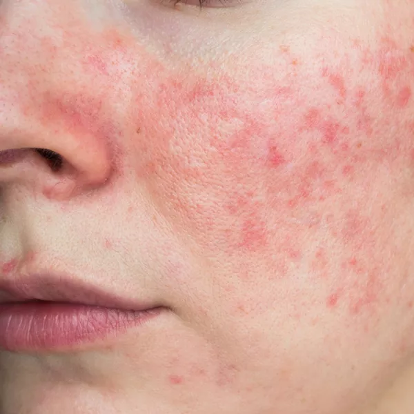 L’acné et l’acné rosacée : une approche naturopathique à Neuville-lès-Vaucouleurs