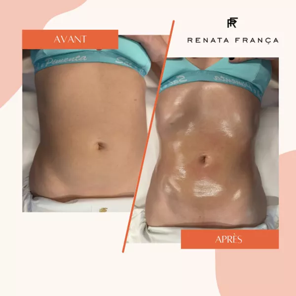 Drainage lymphatique pour ventre relâché