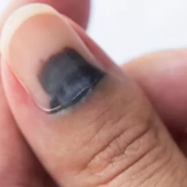 ⚫ Ongles noirs : causes, précautions et solutions