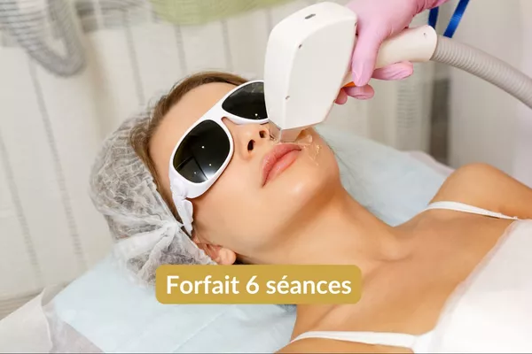 Épilation lumière pulsée Lèvre supérieure - Forfait 6 séances