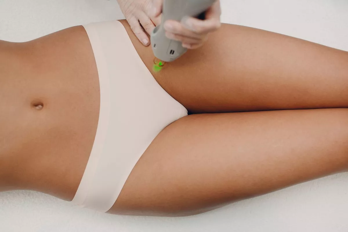Épilation définitive corps au laser diode – Maillot Brésilien