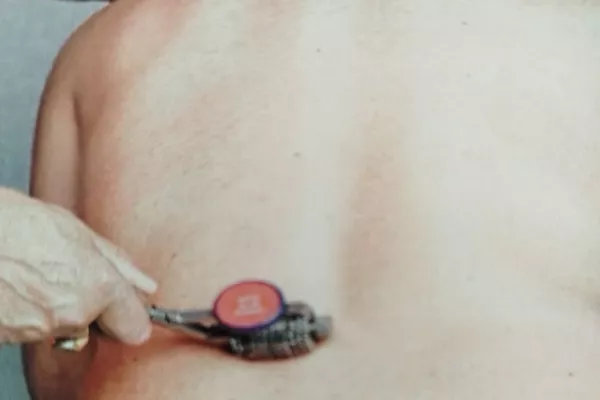 STP- Stimulation Transcutanée Ponctuelle