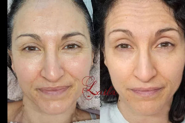 Microneedling Anti-âge & Anti-relâchement visage + cou