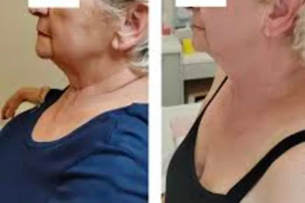 INDIBA – Rajeunissement de la peau du visage  (6 séance)