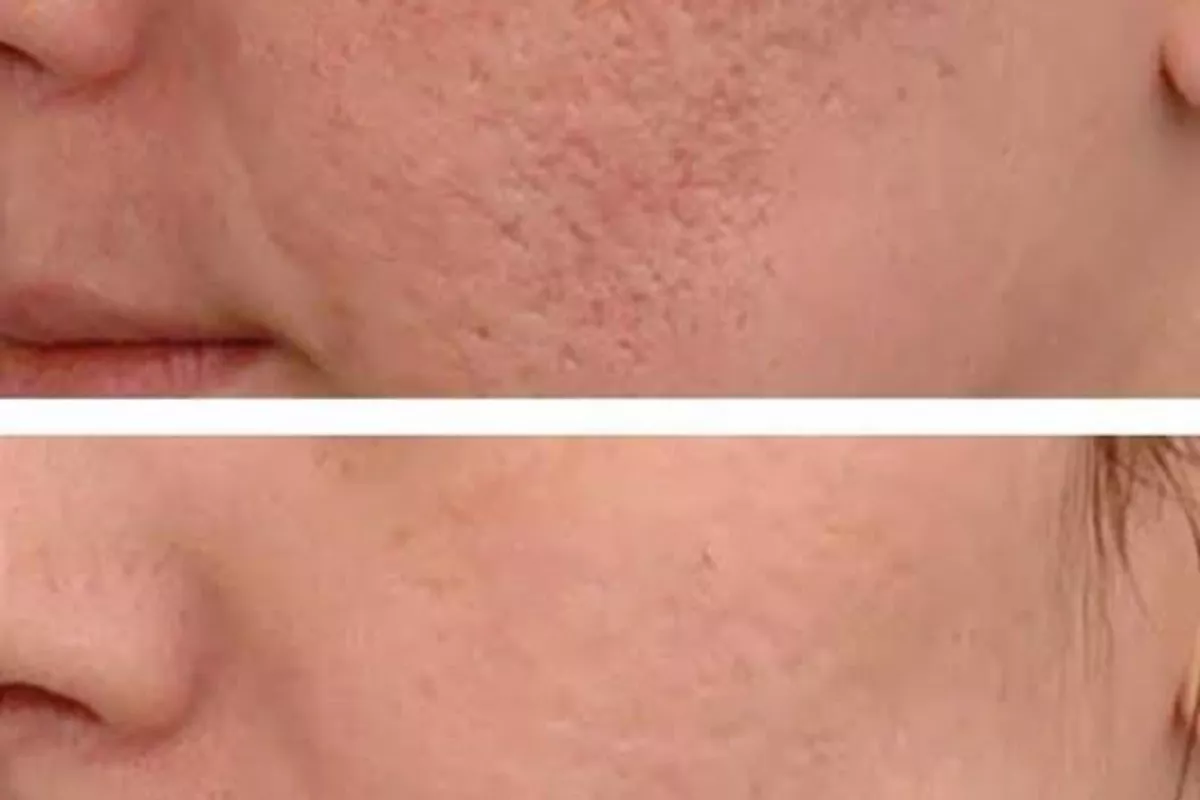 MICRONEEDLING & NANONEEDLING