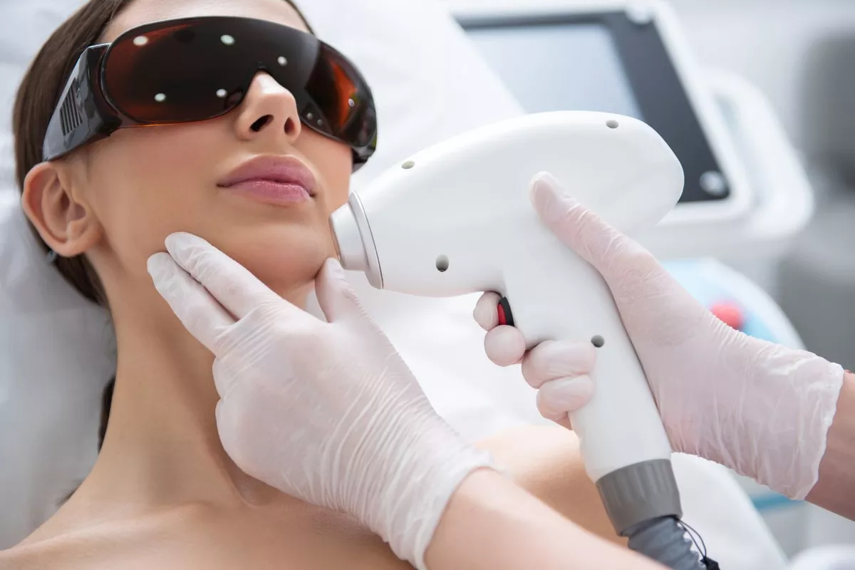 Épilation définitive visage au laser diode – Menton
