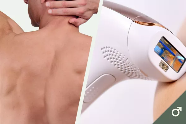 Épilation définitive IPL - Dos complet pour homme
