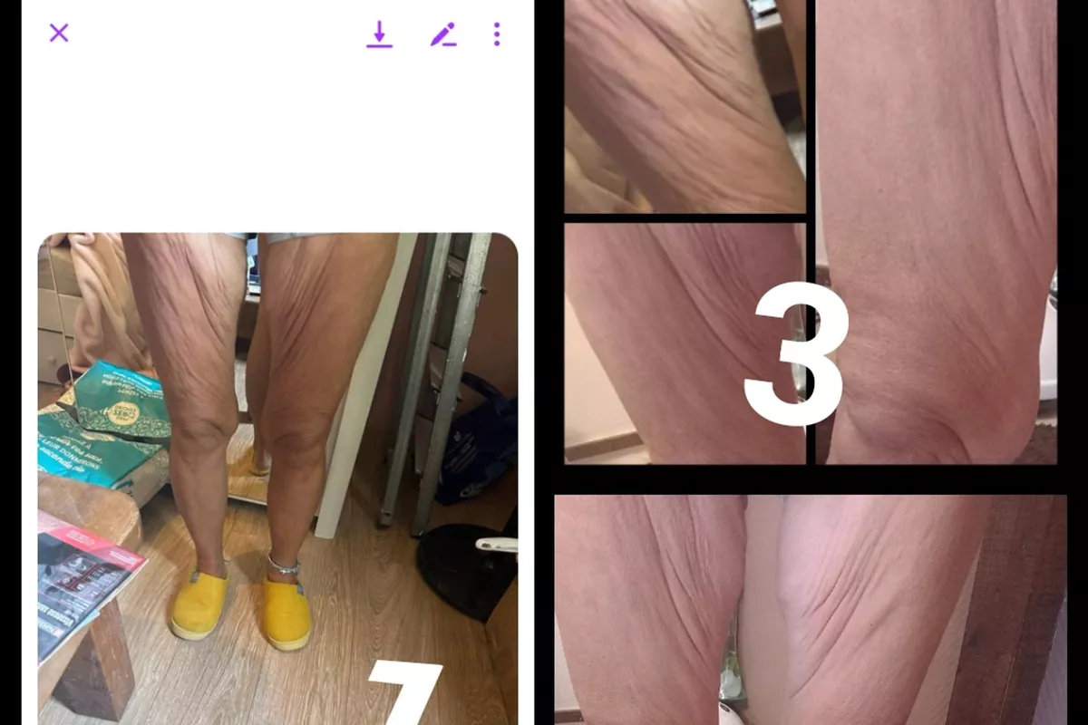 Lipocavitation