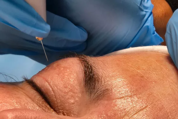 Plasma Froid méthode russe Paupières : l’axité et/ou excédent de peau ( blépharoplastie non chirurgical)