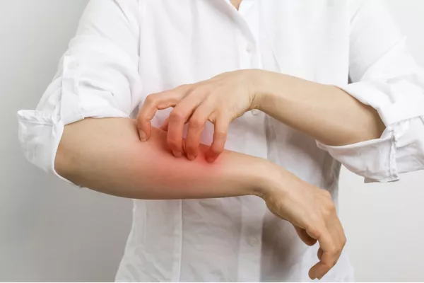 Eczéma et Psoriasis ?