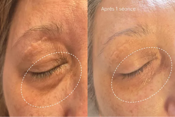 Plasma Froid méthode russe Contour des yeux + paupières