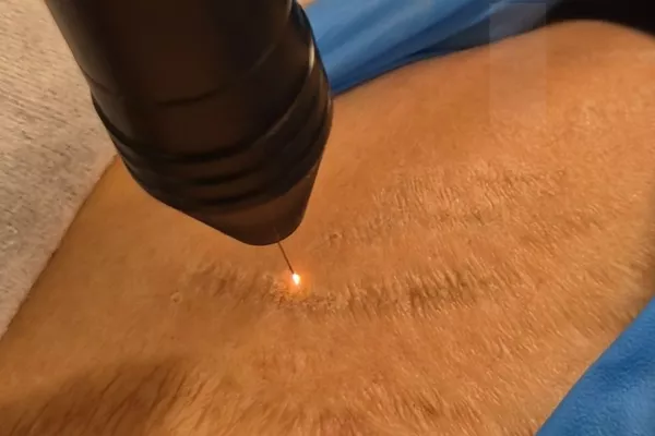 Plasma Froid Vergetures