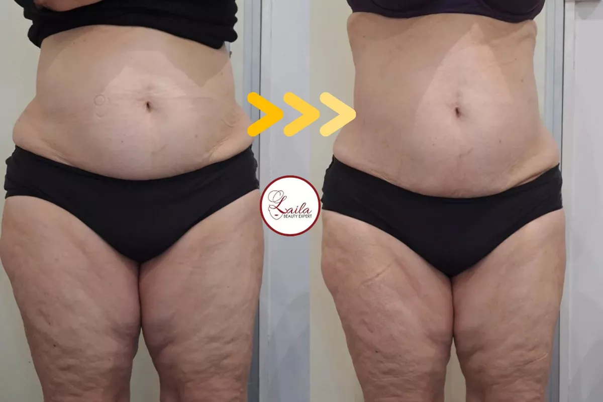 Soins esthétiques sans injection Bois-Guillaume