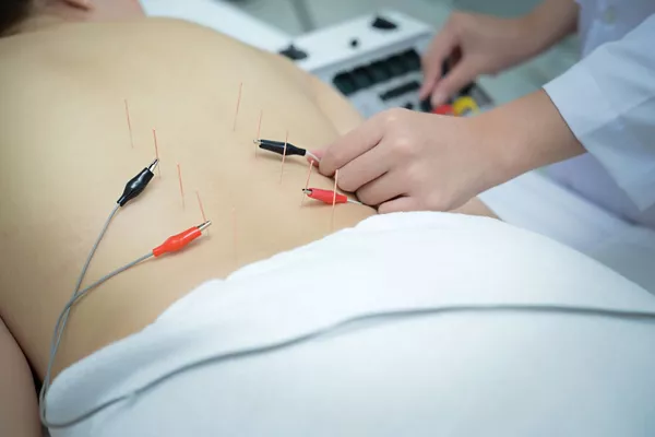 Electro Acupuncture