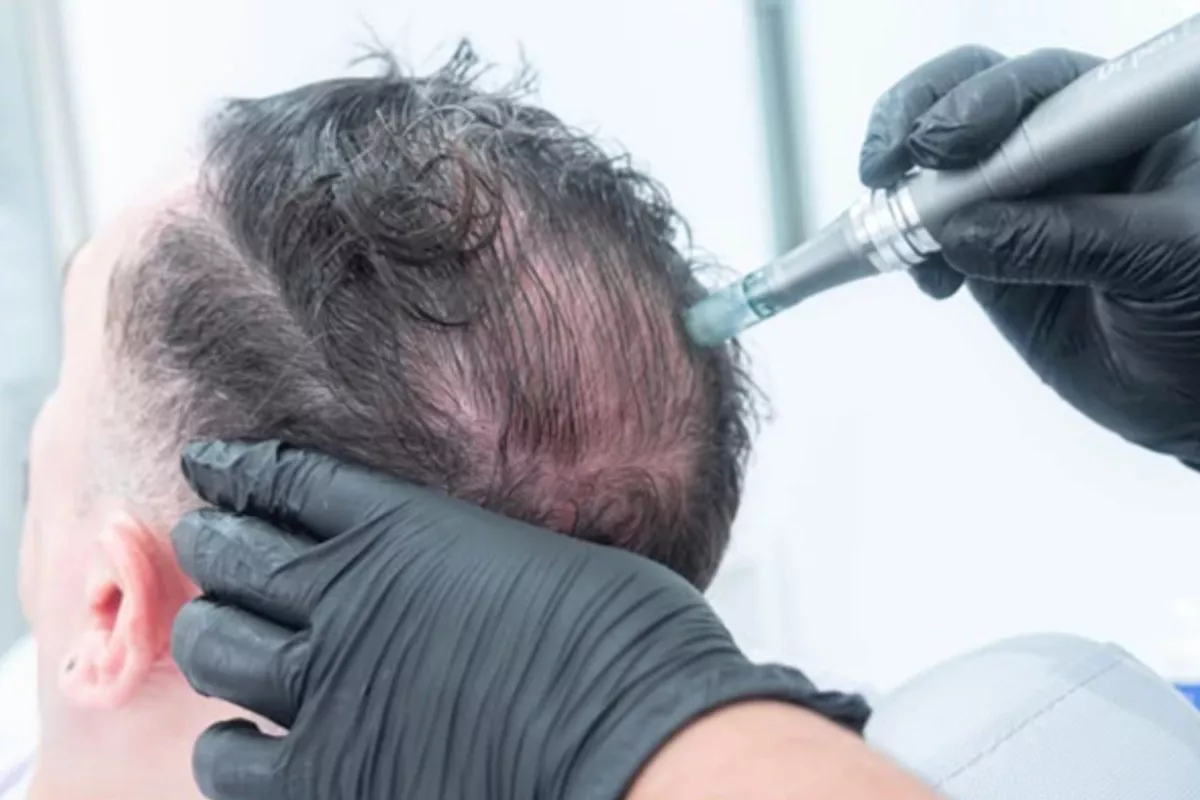 Offre découverte Hair Needling