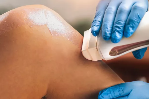 Epilation cuisses