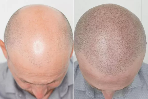 CAPILAIRE OU TRICOPIGMENTATION