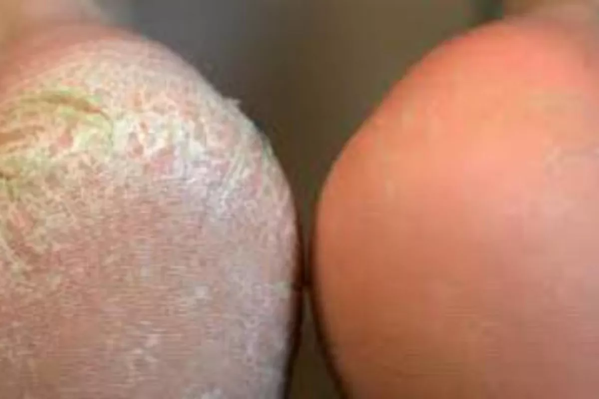 Callus Peel + beauté des pieds
