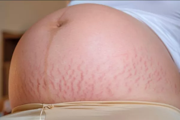 Royal SQT Peeling Bio Vergetures – Abdomen