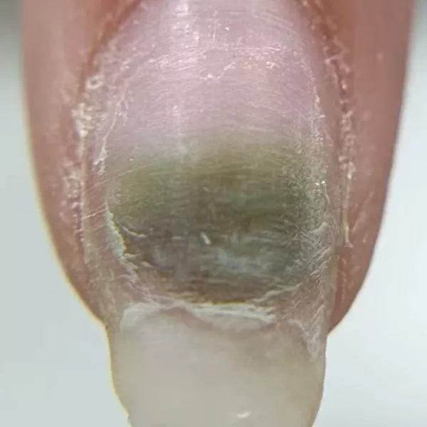 💅 Les infiltrations d’ongles : causes, risques et prévention