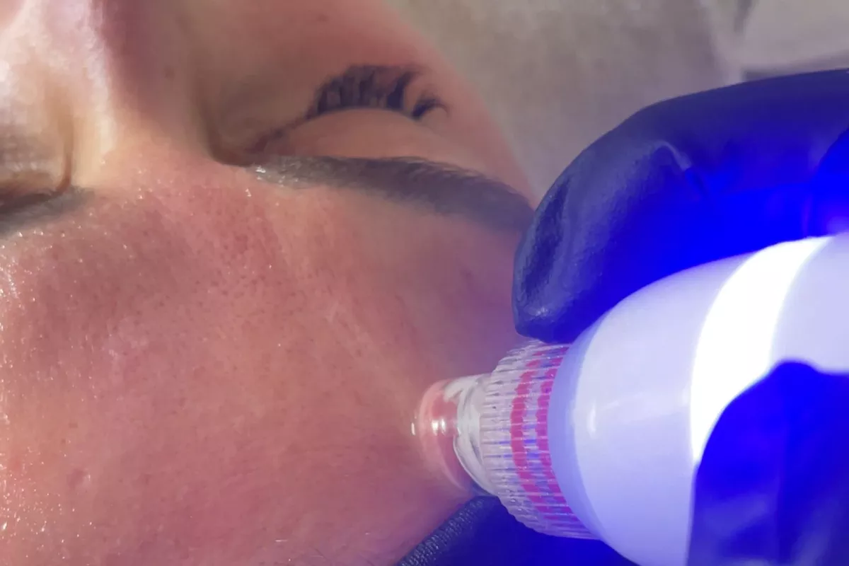 Hydrofacial