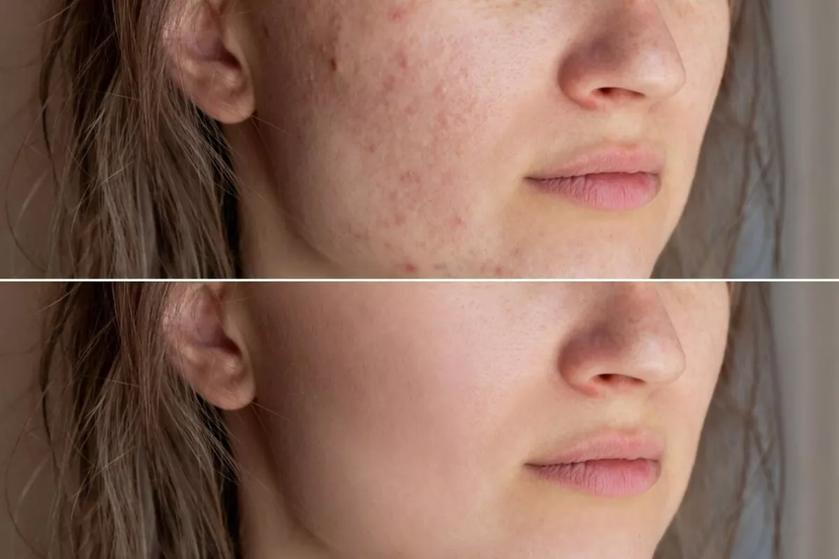 AMTS/ Traitement spécifique des cicatrices & cicatrices d'acné