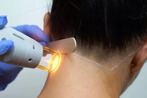 Épilation laser diode : Nuque