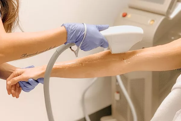Épilation laser diode : Bras entier