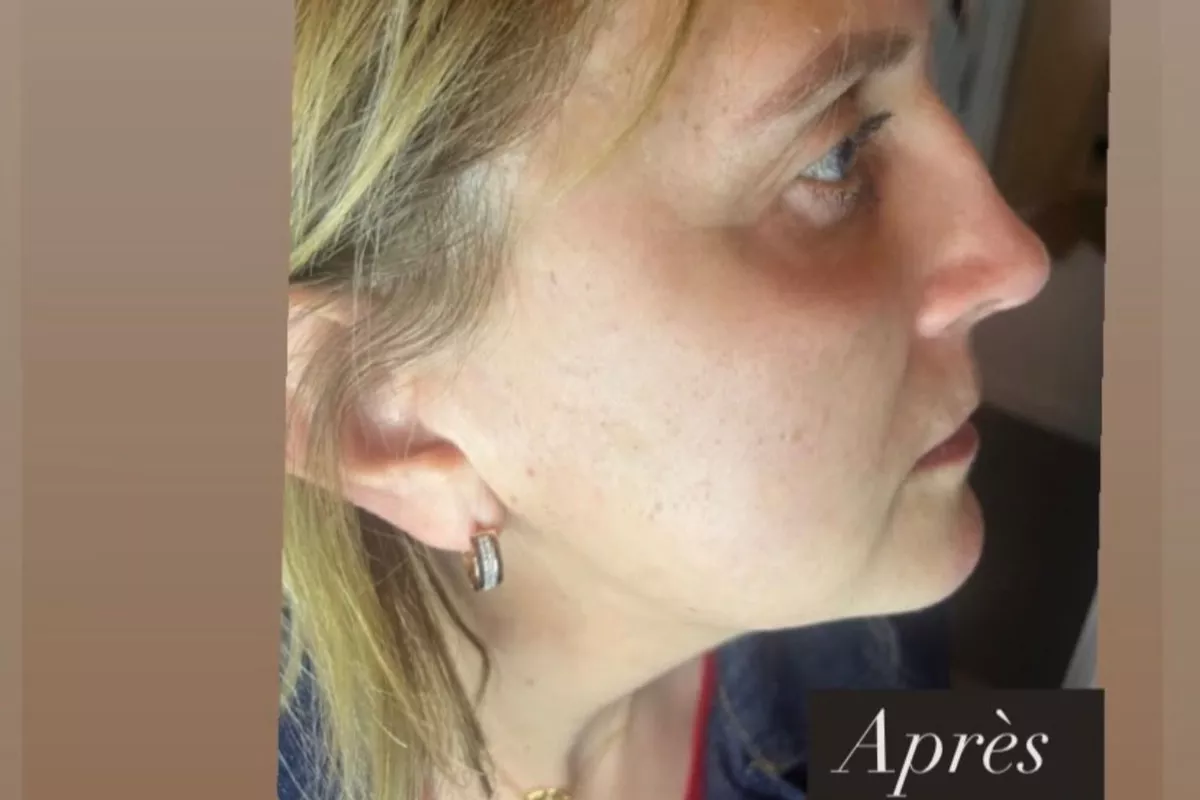 Plasma froid le visage complet avec paupières