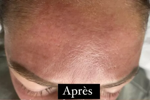 Lifting du front anti rides avec plasma froid