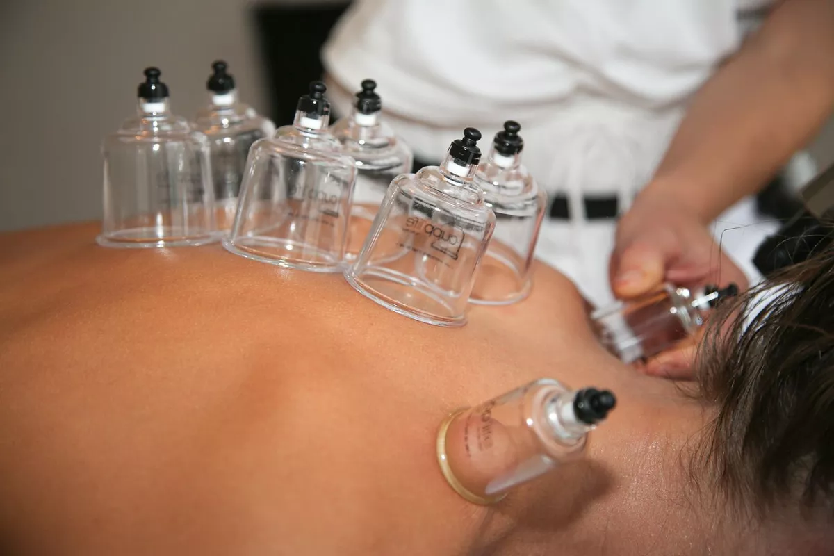 Cupping (ventouses) Nice