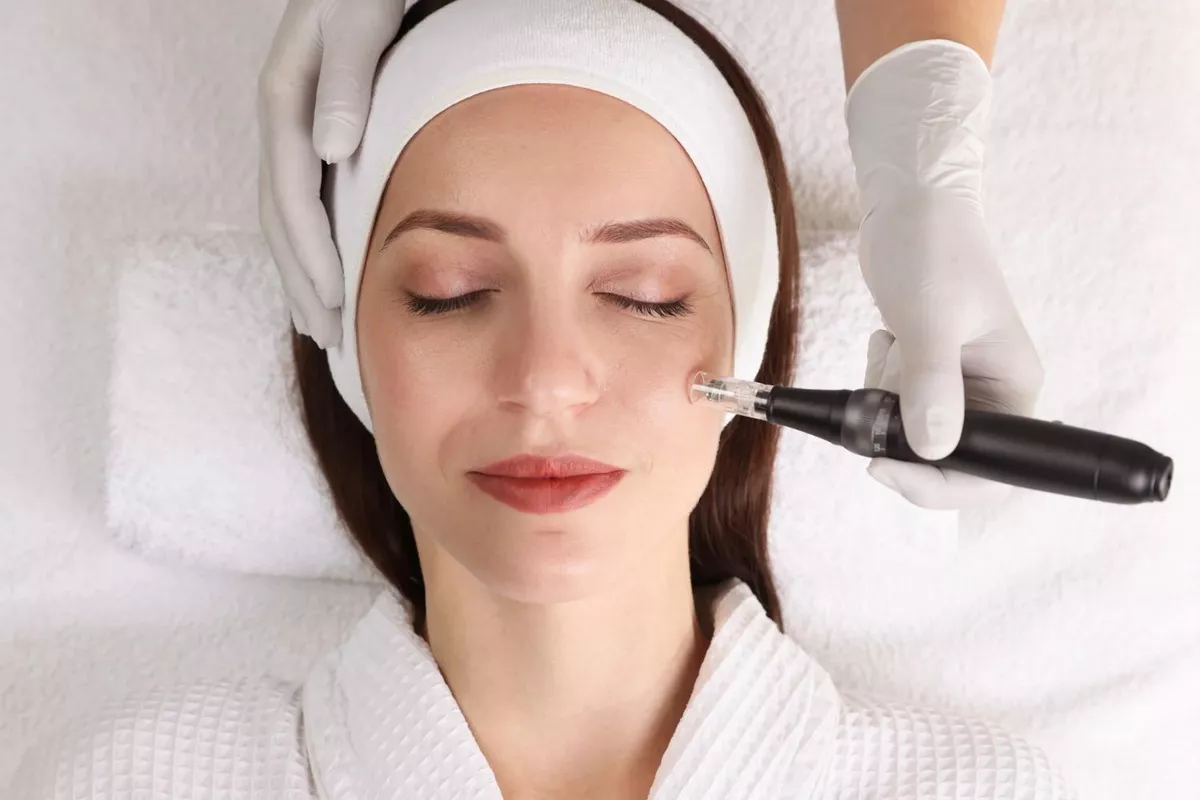 Microneedling forfaits de 4 séance