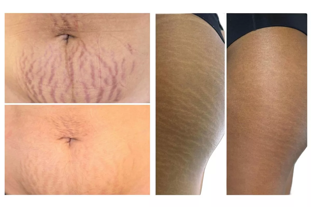 Skin Correct Vergeture - forfait 4 séances - 1 zone