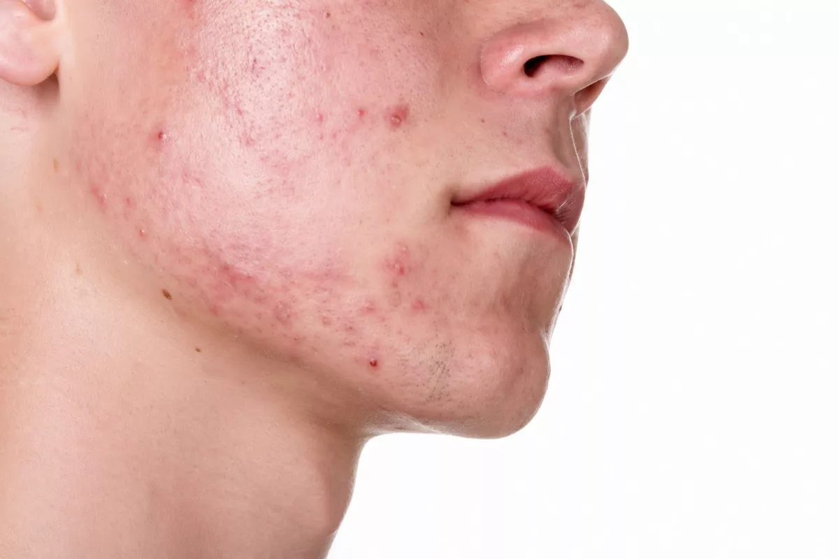 Soin NANONEEDLING ACNE pour homme