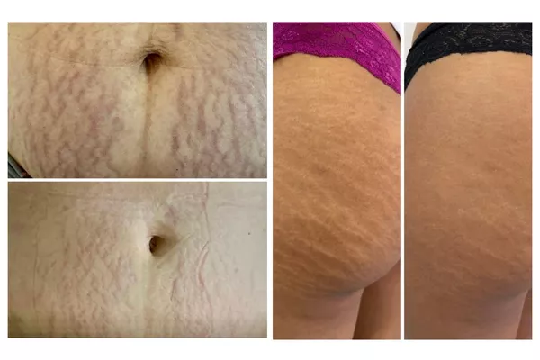 Skin Correct Vergeture 2 zones