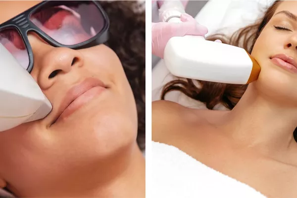 Épilation Laser - Lèvre + Menton
