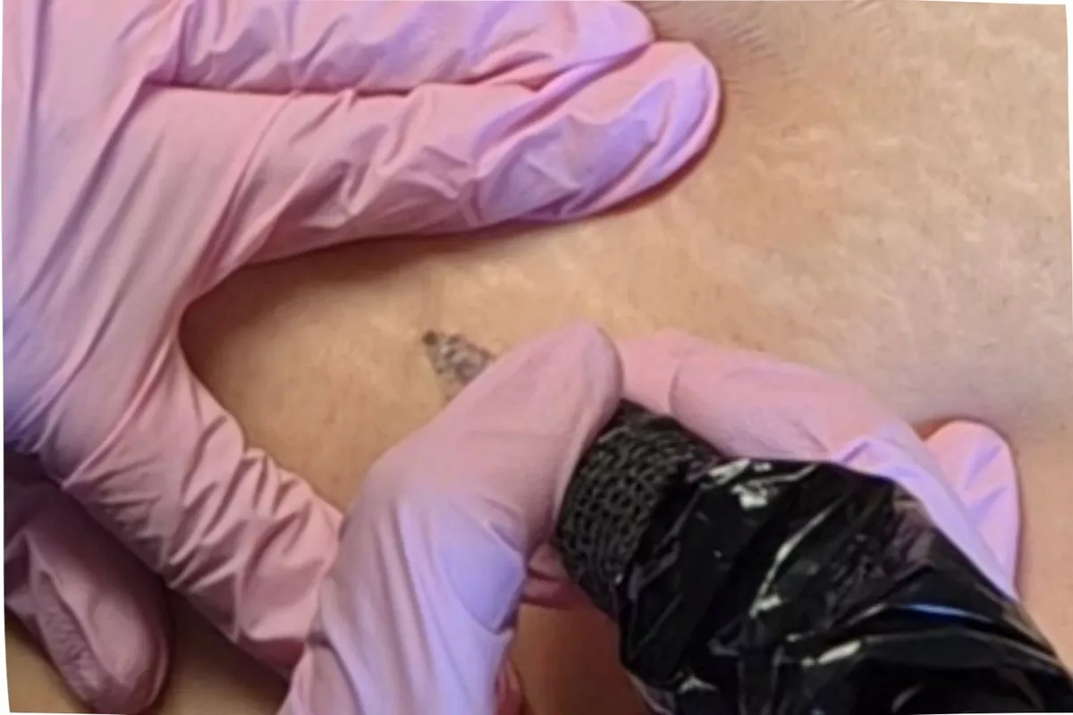 Skin Correct Vergeture 1 zone