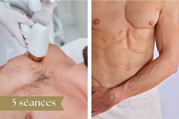 Forfait Épilation Laser Homme 5 séances - Torse ou/ Abdomen