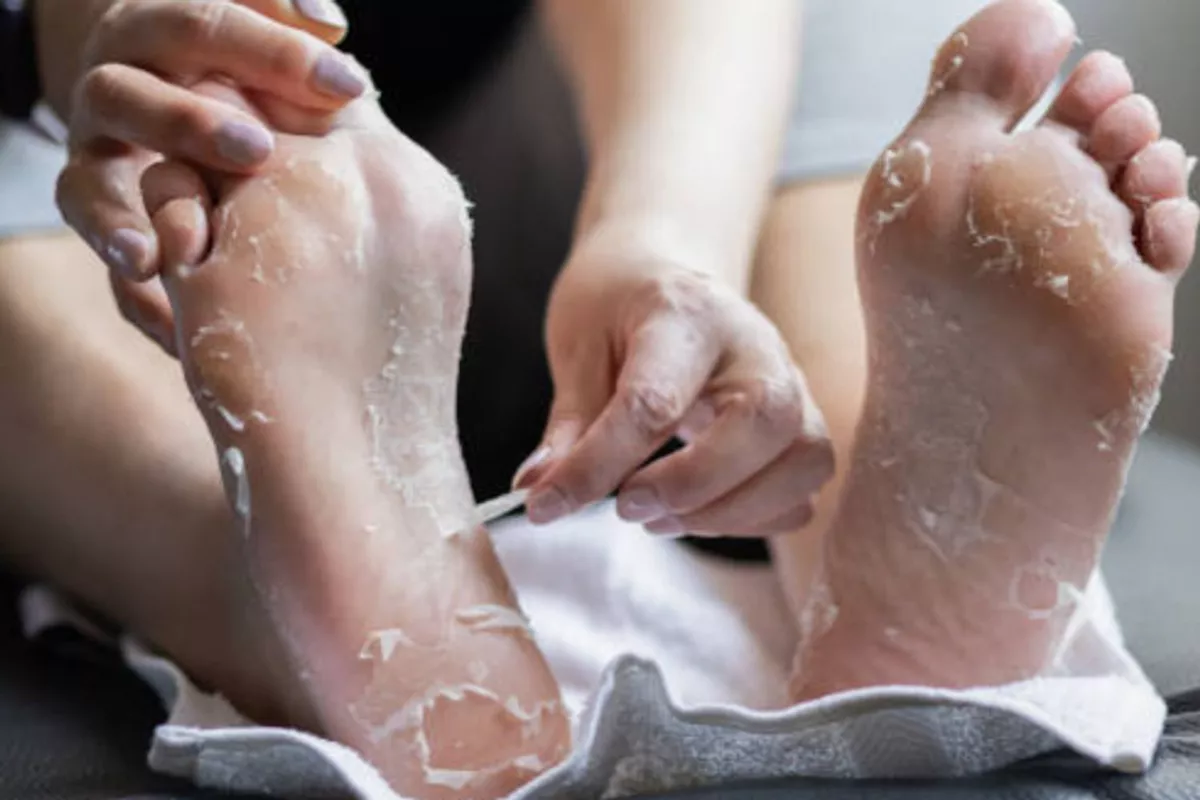peeling des pieds
