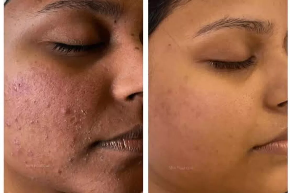 MICRONEEDLING & NANONEEDLING