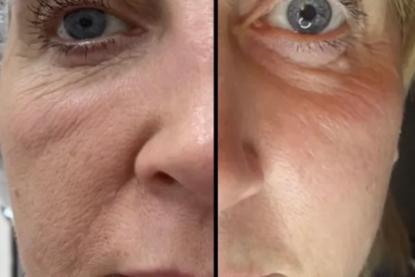 Plasma froid le visage complet avec paupières