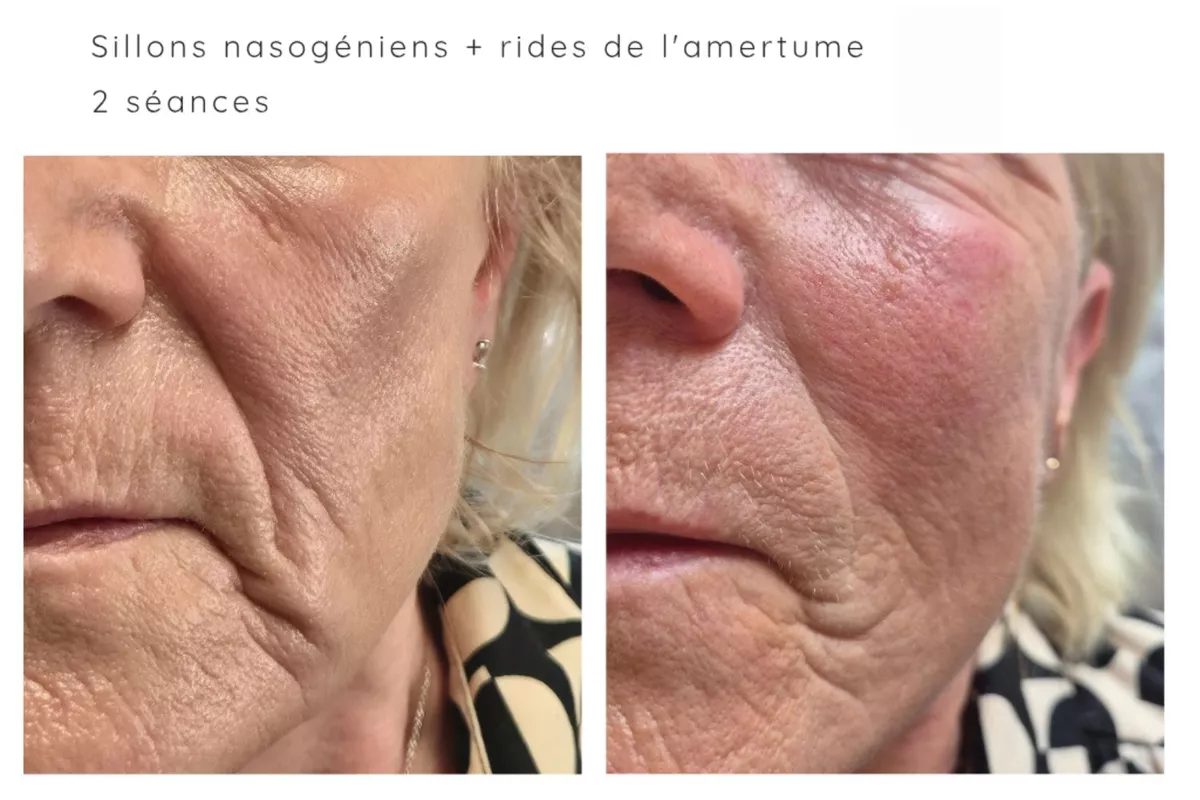 Plasma Froid Russe option zone supplémentaire Visage (hors paupières)