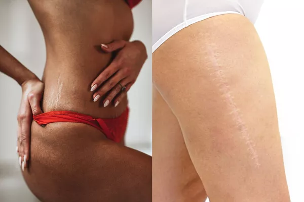 Traitement Vergetures / Cicatrices: Option Peeling