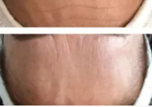 Combien de Séances Endermologie LPG pour des résultats visibles ?