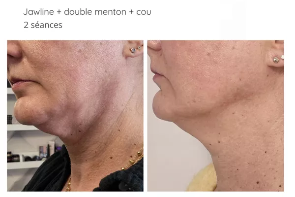 Plasma Froid Russe cou + double menton