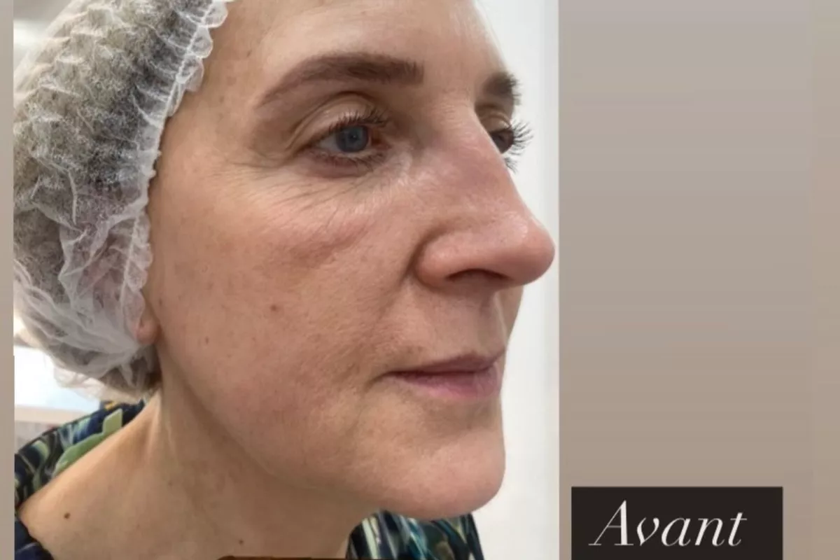 Plasma froid le visage complet avec paupières