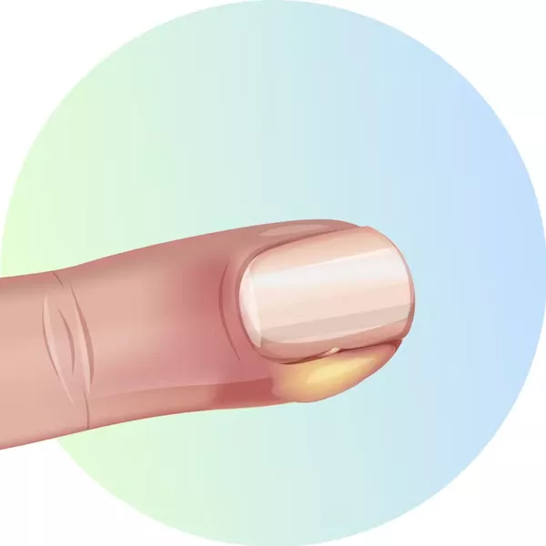 🔴 Panaris : ce qu’il faut savoir pour protéger ses ongles et ses doigts