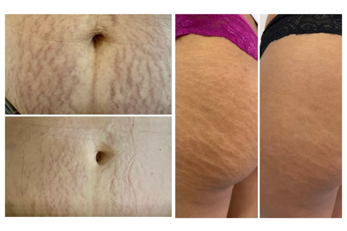 Skin Correct Vergeture 2 zones