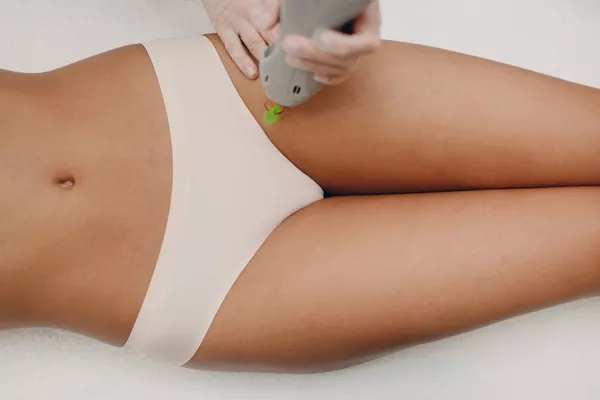Épilation définitive corps au laser diode – Maillot Brésilien