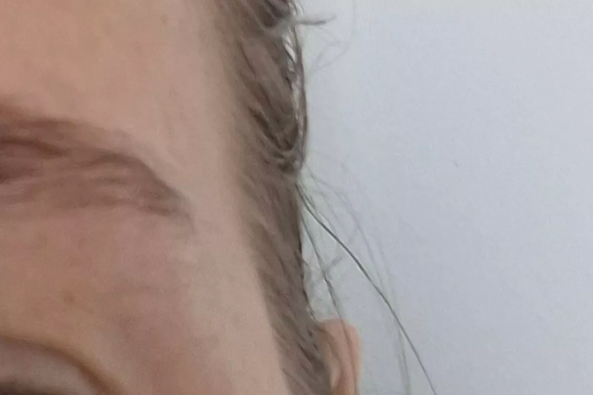 Brow lift : Rehaussement des sourcils